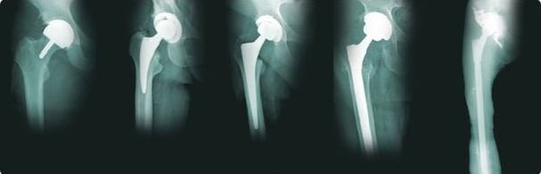 options for hip replacement in osteoarthritis