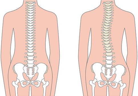 Lower back pain due to a spinal deformity such as scoliosis