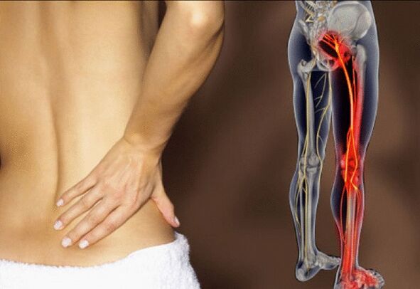 Sciatica