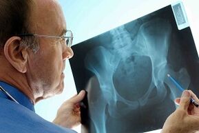 Osteoarthritis of the hip joint on the X -ray