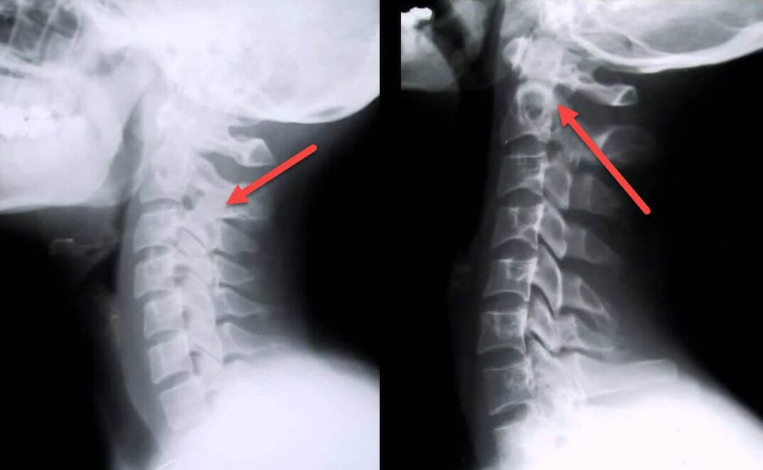 Manifestations of osteochondrosis of the cervical spine on radiography