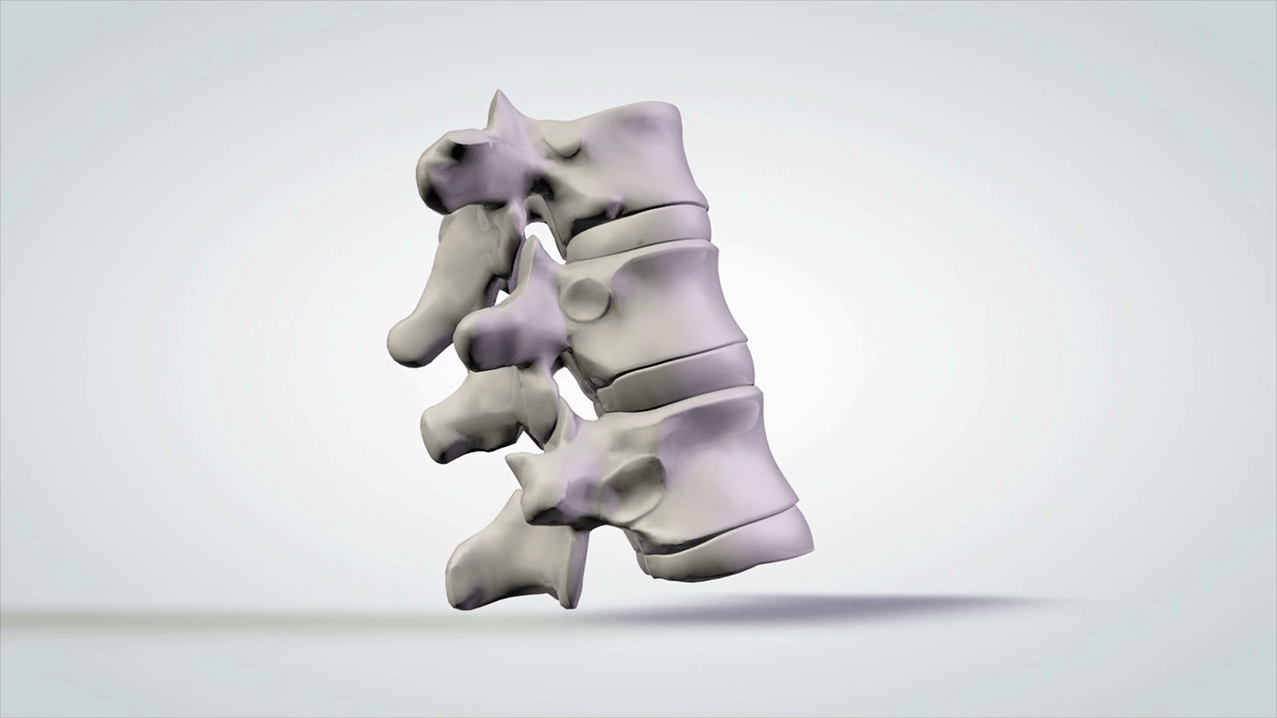 spinal damage due to cervical osteochondrosis