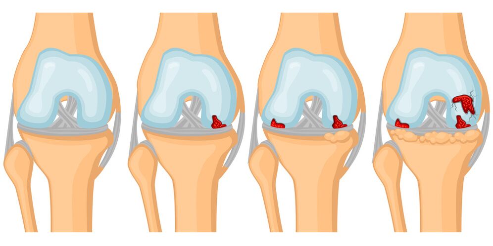 Degree of development of joint osteoarthritis